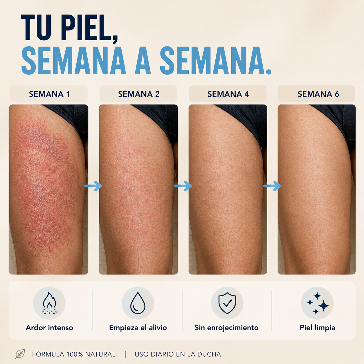 Jabón Zinera® — Antimicótico Natural para Tiña Inguinal